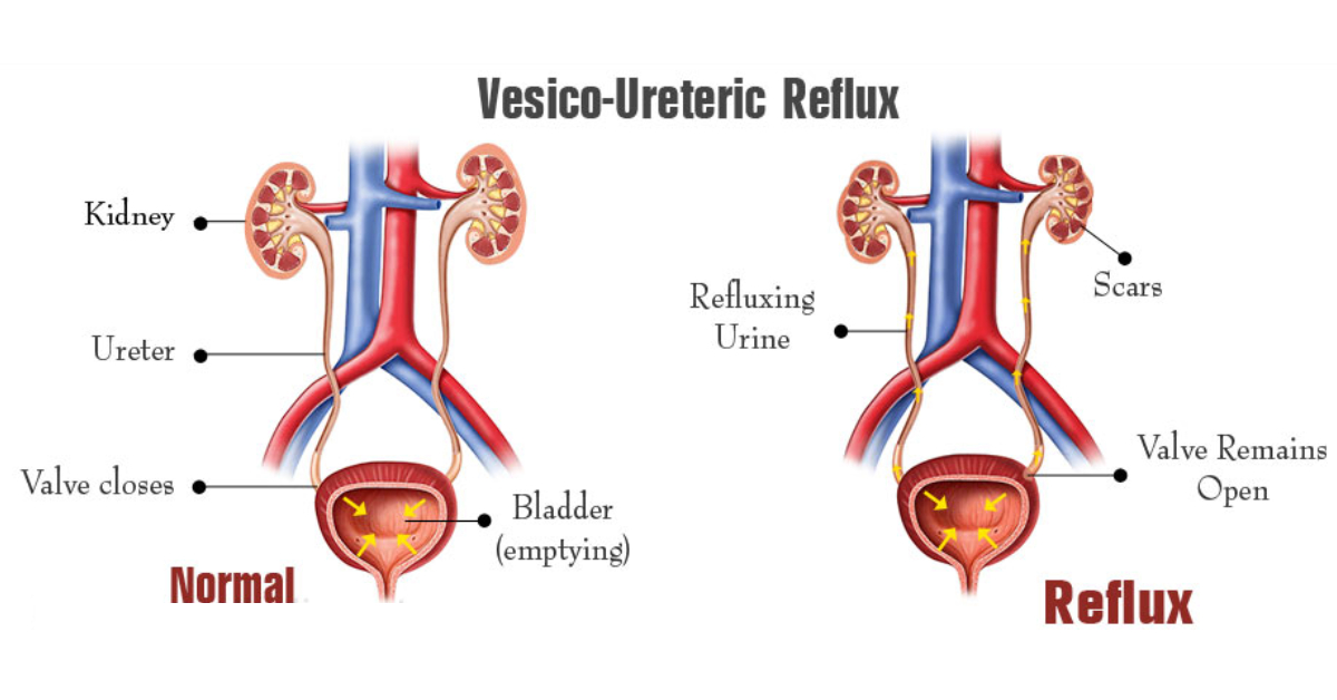 Vesico-Ureteral Reflux